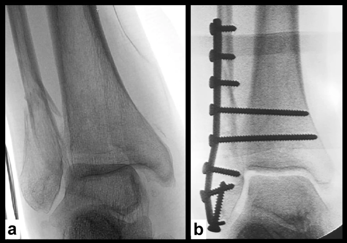 Použití suprasyndesmálních šroubů ke zpevnění osteosyntézy fibuly u osteoporotické zlomeniny a – úrazový snímek, b – stav po operaci