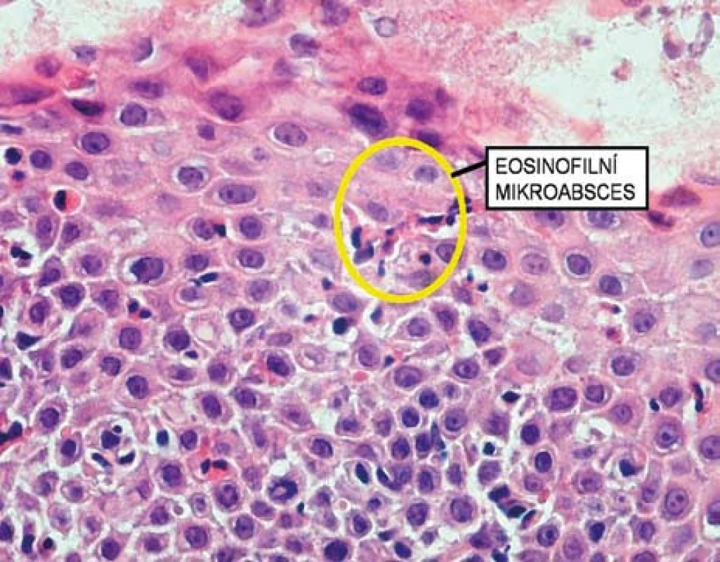 Histologický obraz eozinofilního mikroabscesu.
Fig. 7. Histological image of eosinophilic microabscess.