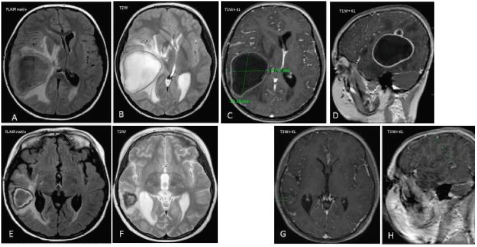 MRI mozgu pred a po liečbe u pacienta č. 1.
A–H. Na MRI zázname sa v axiálnej rovine v sekvencii FLAIR a T2W vážení znázorňuje veľká abscesová dutina s priemerom 65 x 50 mm, presun stredovej čiary a známky intrakraniálnej hypertenzie.
G–H. Diskrétne zmeny v mieste pôvodného abscesového ložiska.
Fig. 1. MRI of the brain before and after treatment in a case 1.
A–H. Axial T2-weighted MRI demonstrate the mass abscess in diameter 65 x 50 mm, and the signs of intracranial hypertension.
G–H. The minimal changes in area of previous abscess.