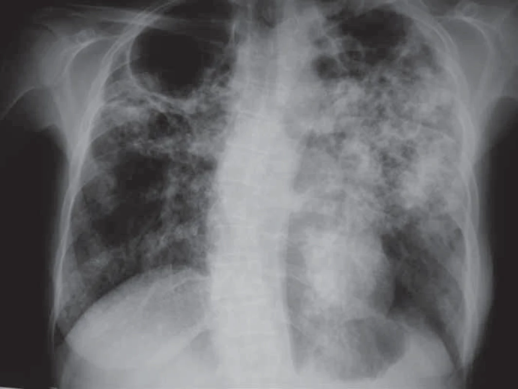 Zadopřední skiagram hrudníku u pacienta s rozsáhlou TB plic s rozpady.