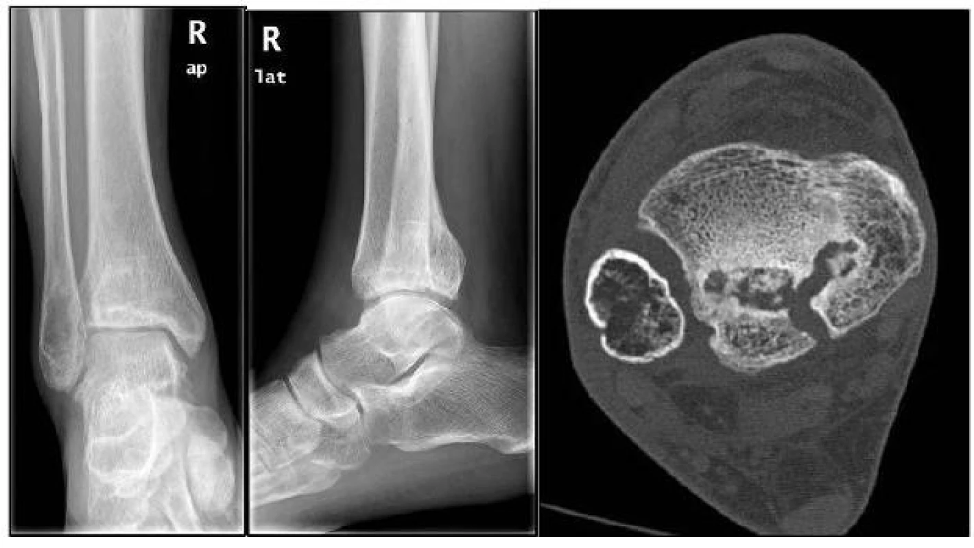 , 18, 19: RTG a CT snímky (2 roky po úraze) ukazují počínající artrotické změny, kostní cysty v oblasti zadní hrany tibie a inkongruenci kloubní plochy tibie