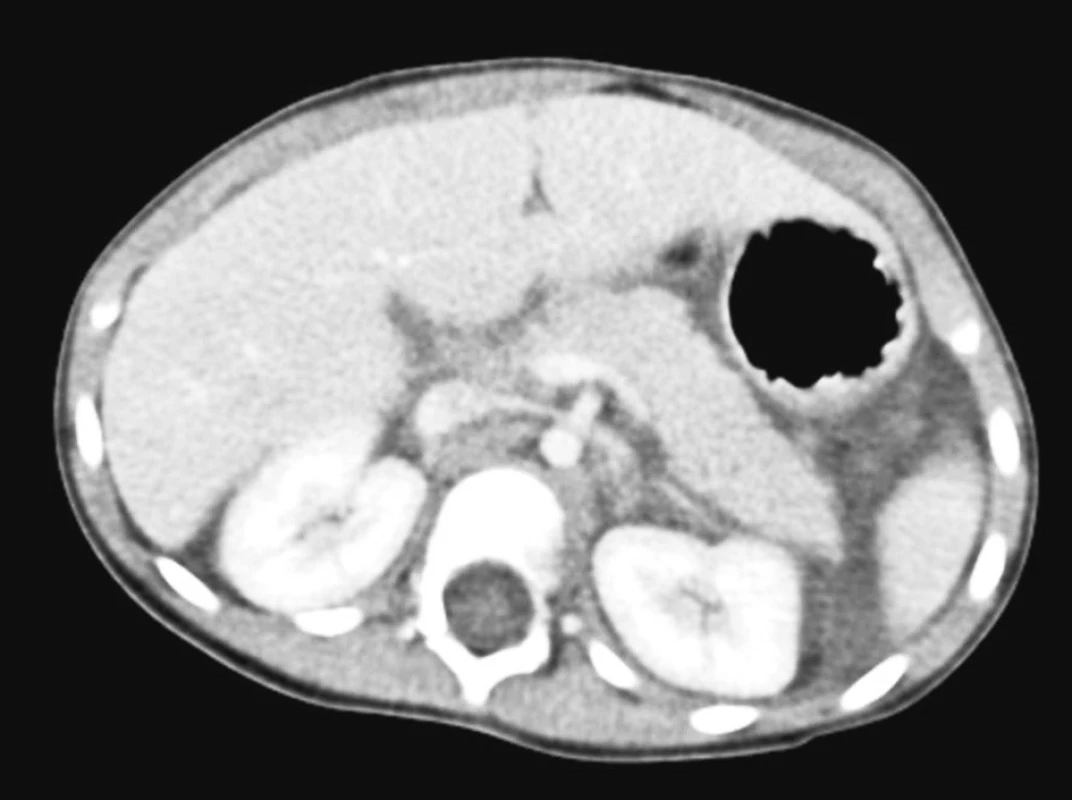 CT obraz – pankreas s diskrétním otokem v okolí, pankreatický vývod nepoškozen
Fig. 5. CT view – a pancreas with a discreet swelling in the surrounding area, the pancreatic duct is intact