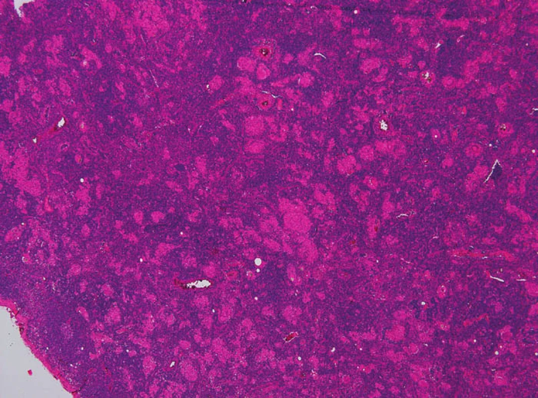 Granulomatózní proces v lymfatické uzlině
Fig. 3: Granulomatous process in a lymph node