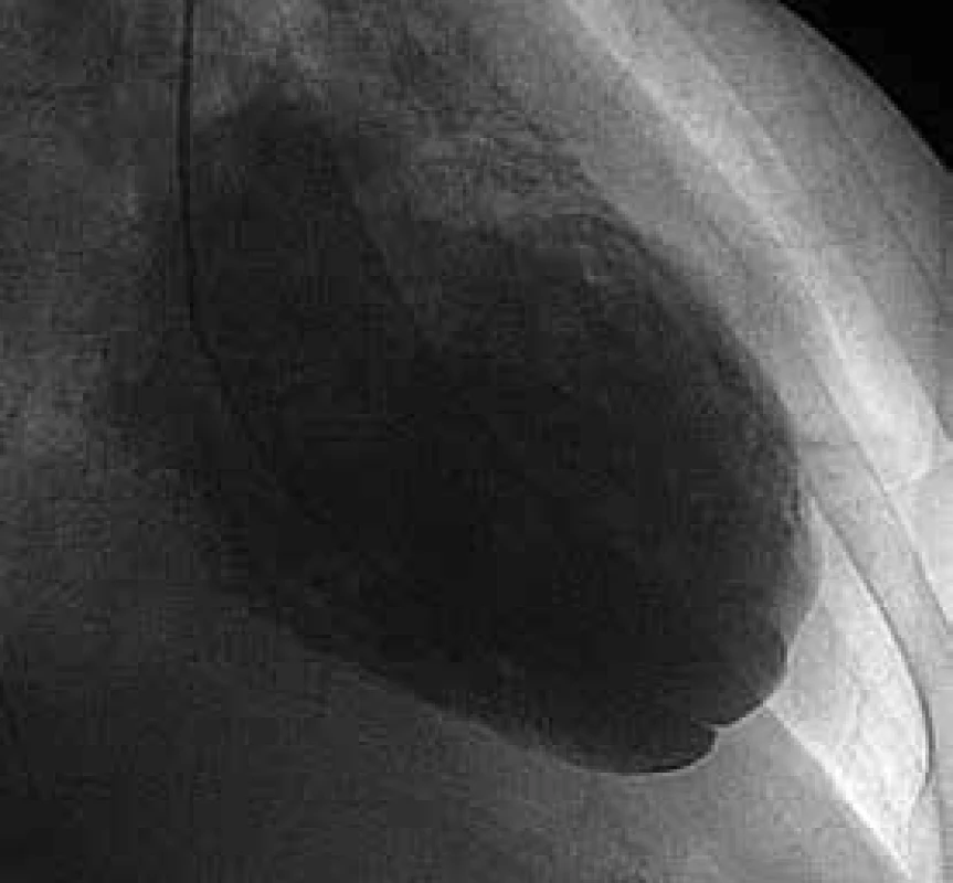 Ventrikulografie zachycující nehomogenní obraz stěn levé komory srdeční