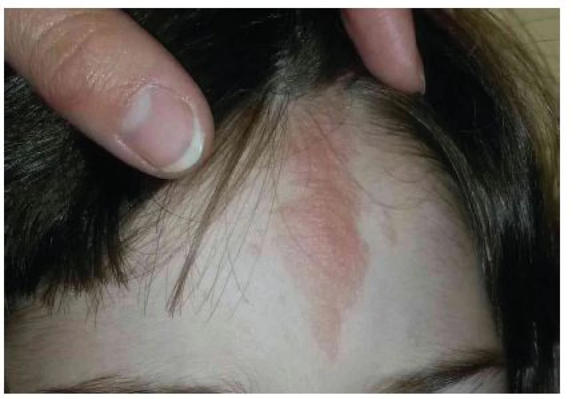 Fibrózní plak na čele u 8leté dívky