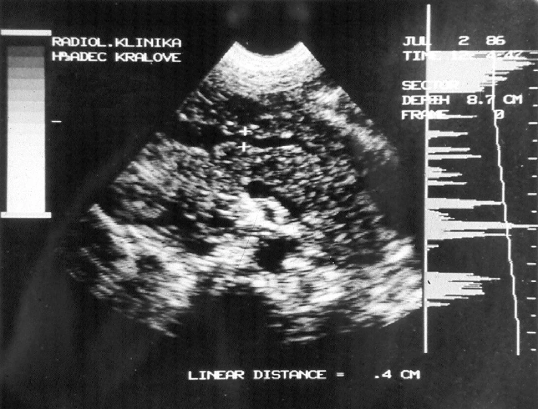 Ultrazvukový obraz pankreatu s dilatovaným pankreatickým vývodem (šíře označena značkami) – patrny jsou i rozšířené sekundární pankreatické větve