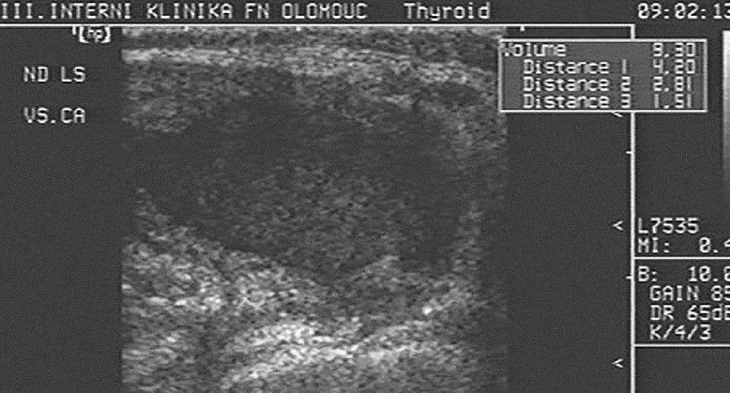Ultrazvukový obraz uzlu levého laloku štítné žlázy. příčný řez