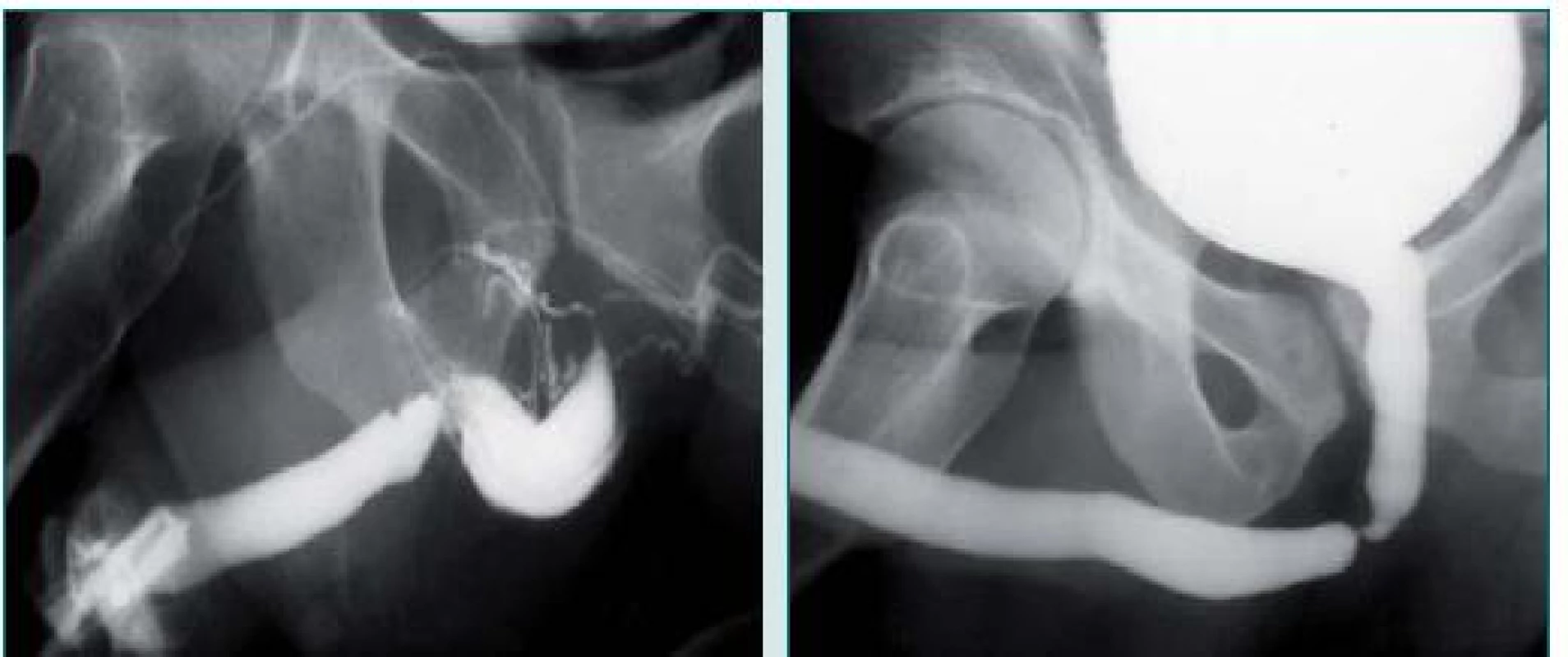 Uretrální striktura bulbární a penilní močové trubice v důsledku tupého traumatu. Uretrografie 4 měsíce po poranění.