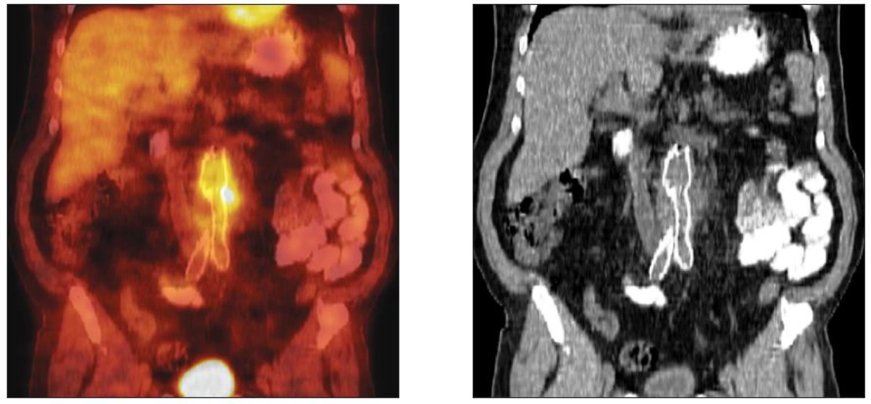 CT vs. FDG-PET/CT obraz infekce oboustranného aortofemorálního bypassu
Fig. 3. CT vs. FDG-PET/CT pattern of the infected aortobifemoral bypass graft
