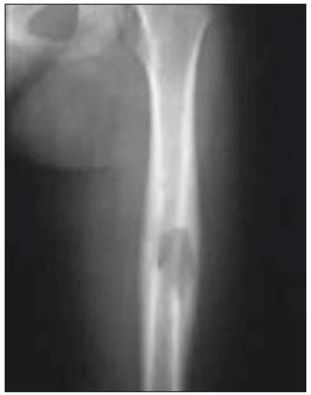 Osteolytické ložisko ve femuru (RTG vyšetření).
