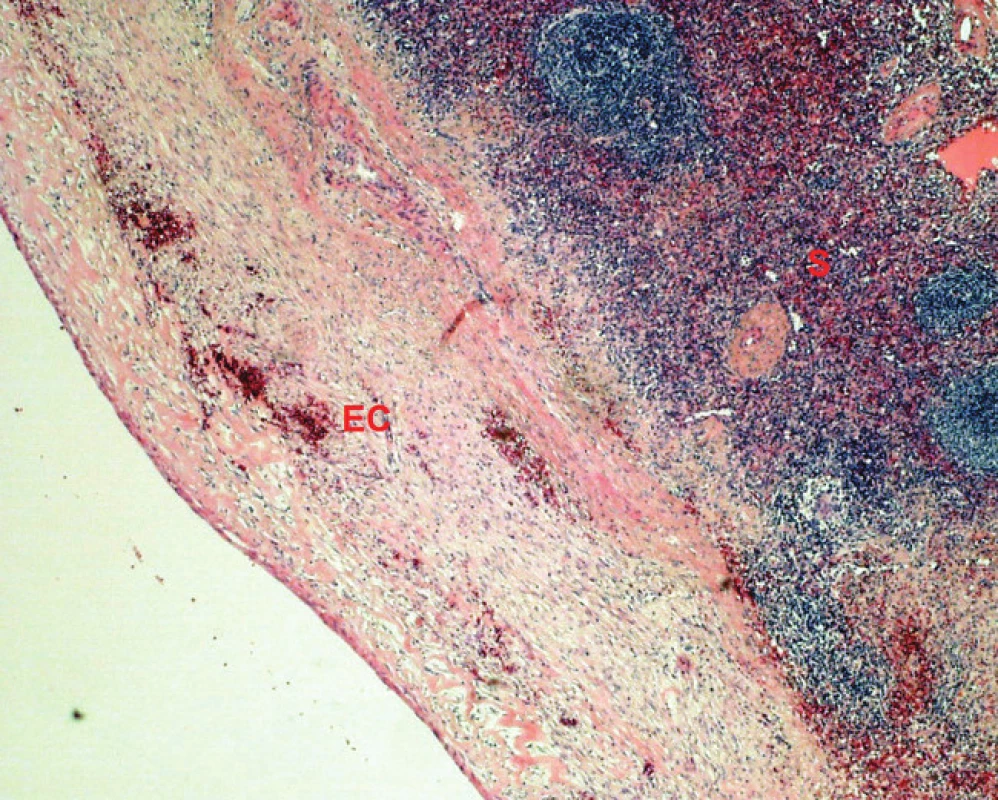 Mikroskopický nález (barvení H&amp;E, 50x) stěna cysty intrapankreaticky uložené sleziny, EC – tkáň epiteliální cysty, S – tkáň akcesorní sleziny.
Fig. 6: Microscopic finding (H&amp;E staining, 50x) wall of the cyst of intrapancreatic accessory spleen, EC – tissue of the epithelial cyst, S – tissue of accessory spleen.