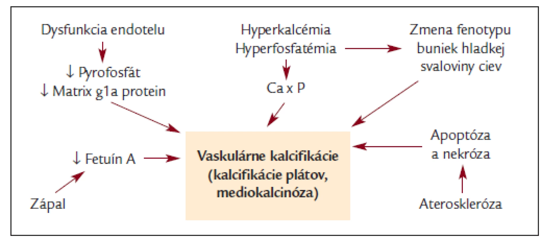 Schéma etiopatogenézie vaskulárnych kalcifikácií.
