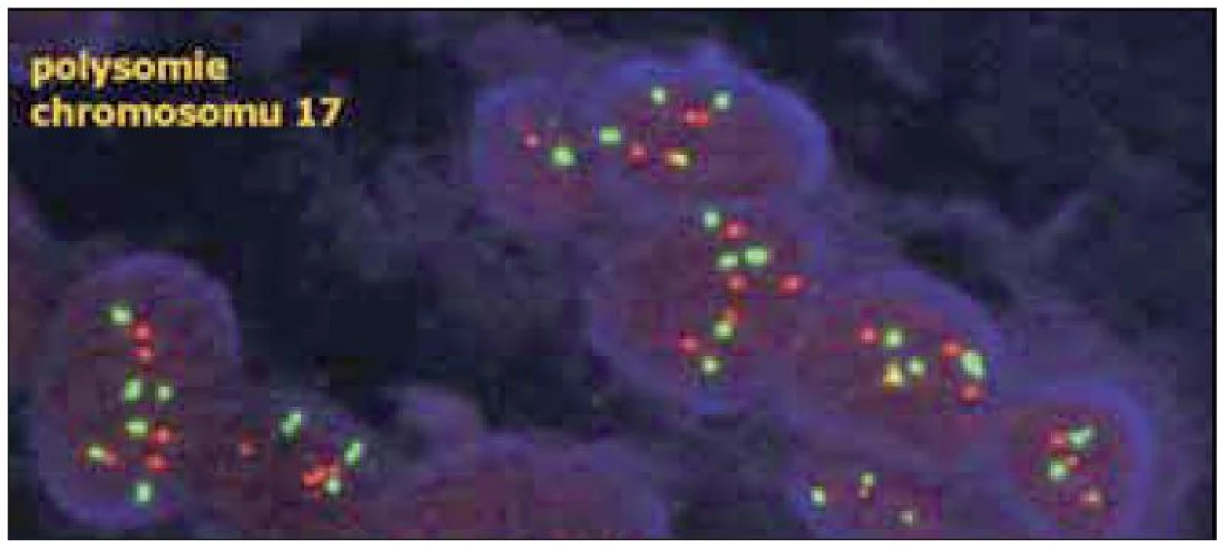 V případě polysomie chromozomu 17 je zvýšen nejen počet červených signálů genu HER2, ale také počet červených centromerických signálů – poměr mezi však zůstává obdobný, jako u normálních buněk.(dle www.patologie.info.cz