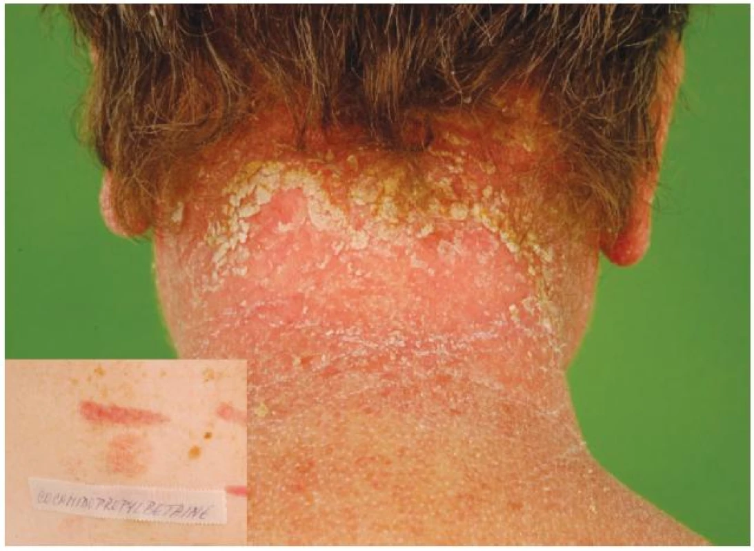 a) Eczema contactum – kokamidopropylbetain (šampony)
b) Epikutánní test – alergická reakce na kokamidopropylbetain