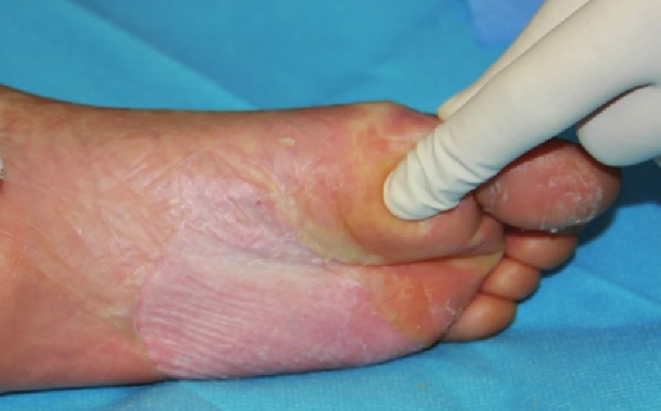 Zhojené plochy po xenotransplantaci na plosce levé nohy
Fig. 7: Healed areas following xenotransplantation on the sole of the left foot