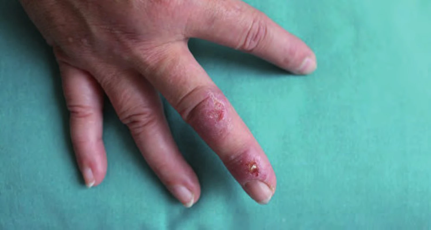 Dva defekty na třetím prstu pravé ruky před léčbou.