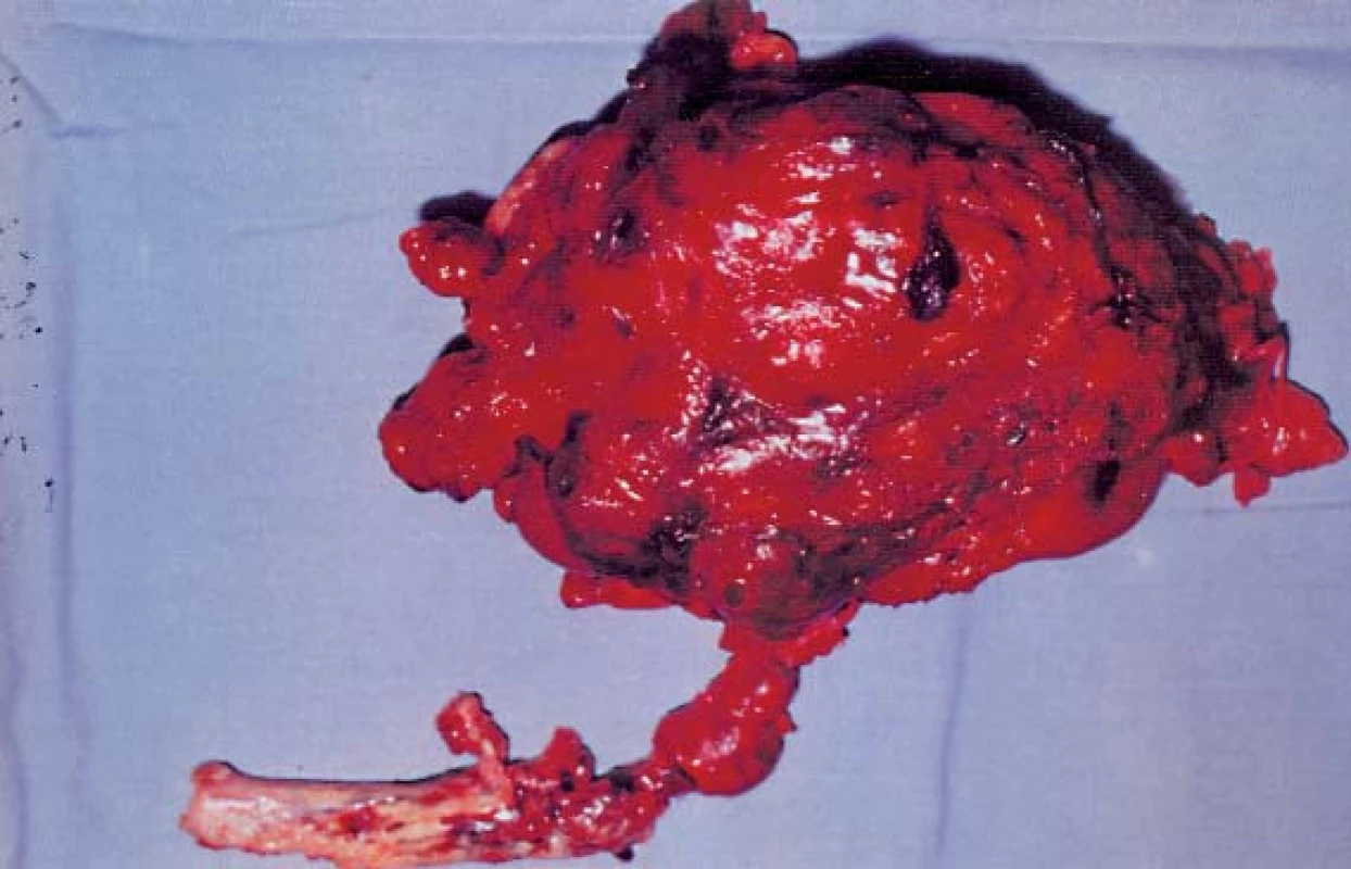 Odstraněná ledvina s nádorem a válcovitým trombem (hladina IV, operace v CPB).
