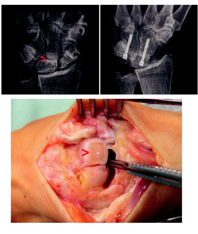 a) Pakloub člunkové kosti s artrotickými změnami typu SNAC III, šipka ukazuje oblast postižení mediokarpálního kloubu se zúžením kloubní štěrbiny a subchondrální sklerózou.
b) Peroperační nález u téhož pacienta, šipka ukazuje na úplnou ztrátu chrupavky v oblasti hlavice os capitatum.
c) Stav po zhojené čtyřrohé fúzi pomocí kostních štěpů a 2 šroubů Herbertova typu.