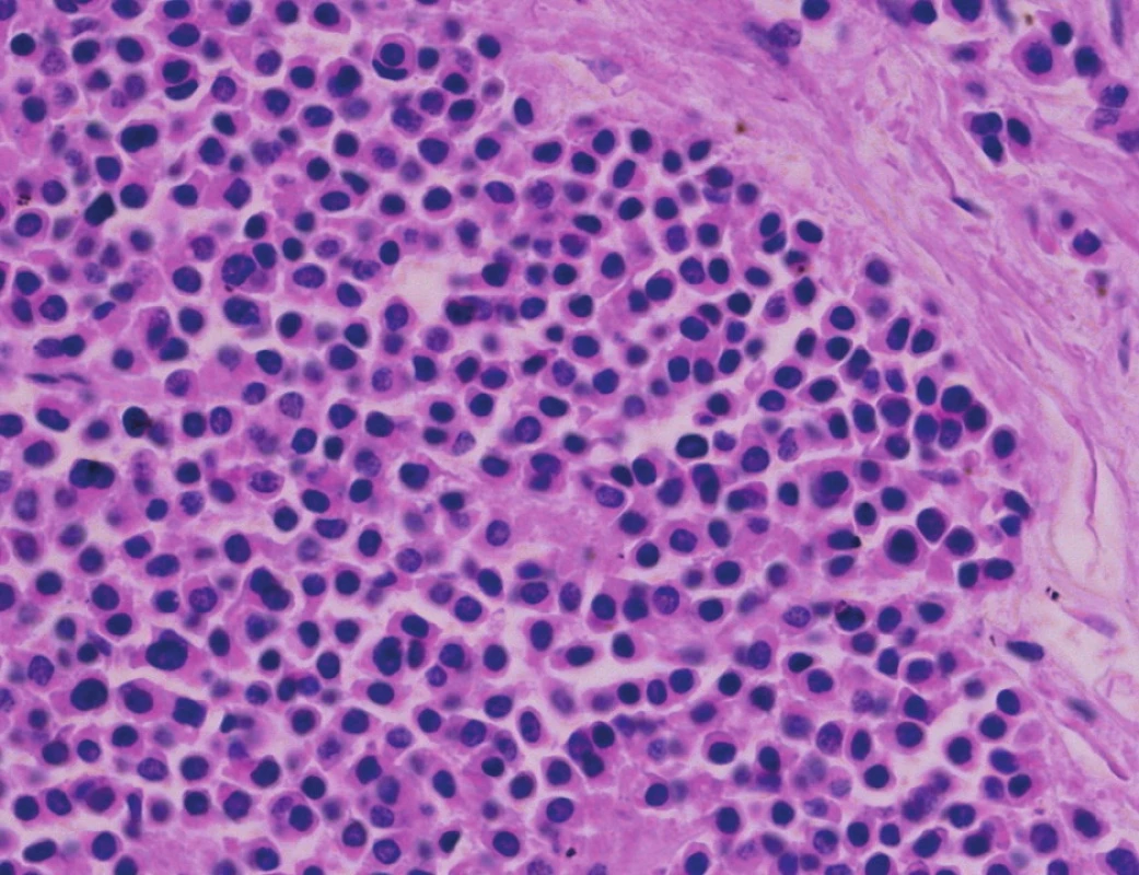 Ložiskovitě nádor přechází do středně velkých a malých buněk. HE, 400x