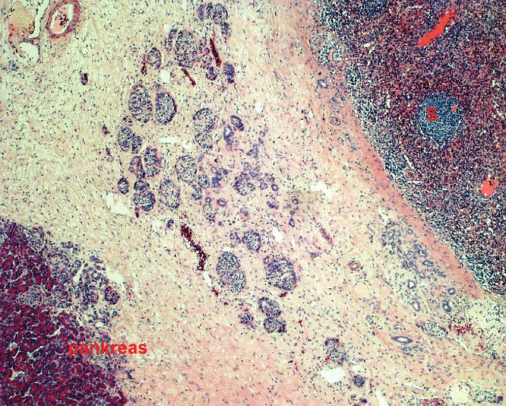 Mikroskopický nález (barvení H&amp;E, 50x) intrapankreaticky uložené sleziny (tkáň v pravém horním rohu), EC – tkáň epiteliální cysty, S – tkáň akcesorní sleziny.
Fig. 5: Microscopic finding (H&amp;E staining, 50x) intrapancreatic accessory spleen (tissue in the right upper corner), EC – tissue of the epithelial cyst, S – tissue of accessory spleen