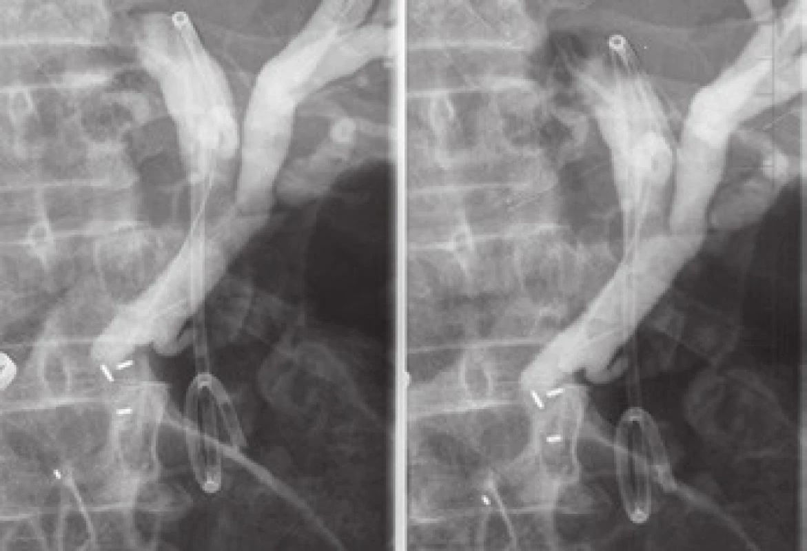 Zavedený double pig tail stent v RTG obrazu.
Fig. 4. Implanted double pig tail stent in X-rays image.