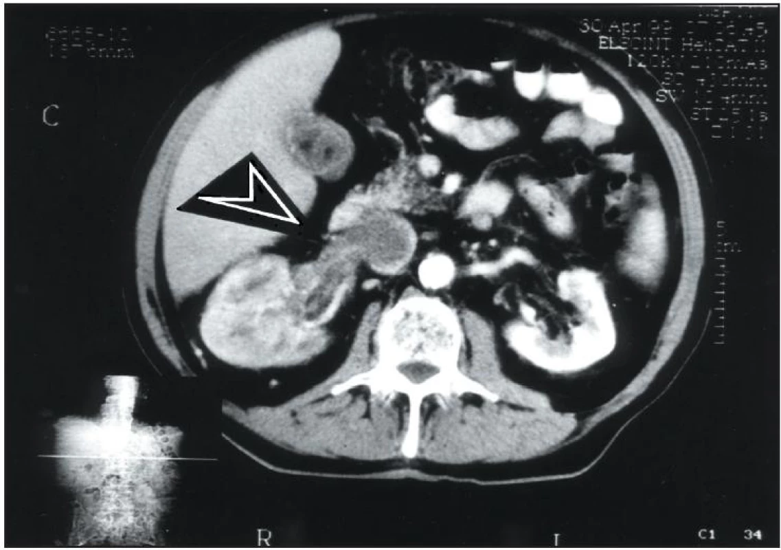 CT snímek ukazuje karcinom ledviny, který prorůstá do renální žíly a dále do dolní duté žíly. To vysvětluje scintigrafický nález obstrukce dolní duté žíly s rozvojem portokaválních spojek a zobrazením jater &lt;sup&gt;(1 - 5)&lt;/sup&gt;.
