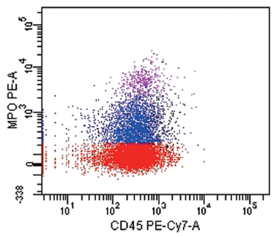 Akutní leukemie se smíšeným fenotypem T/My (WHO 2008). T lymfoidní komponenta (červeně): CD1a+, cCD3+,CD7+, CD34+, CD45 slabě. Myeloidní komponenta (modře): CD13+ (zde nezobrazeno), CD33+, MPO+, CD45 slabě.