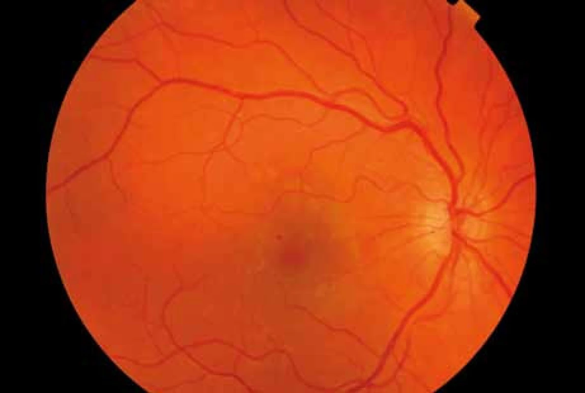 Barevný snímek fundu pravého oka v 16. týdnu gravidity.