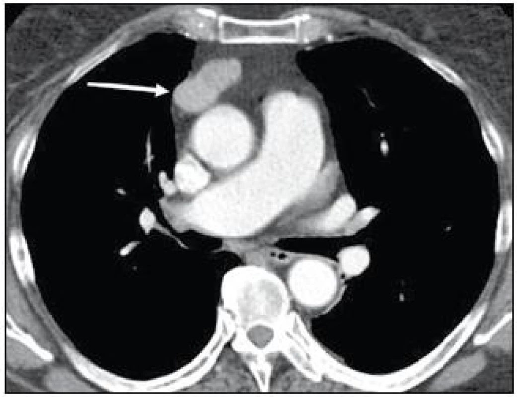 CT hrudníku v arteriální fázi po intravenózní aplikaci kontrastní látky: laločnatá dobře ohraničená expanze v předním mediastinu s lehce nehomogenní opacifikací po aplikaci o velikosti 40 × 27 × 20 mm (kazuistika 1).