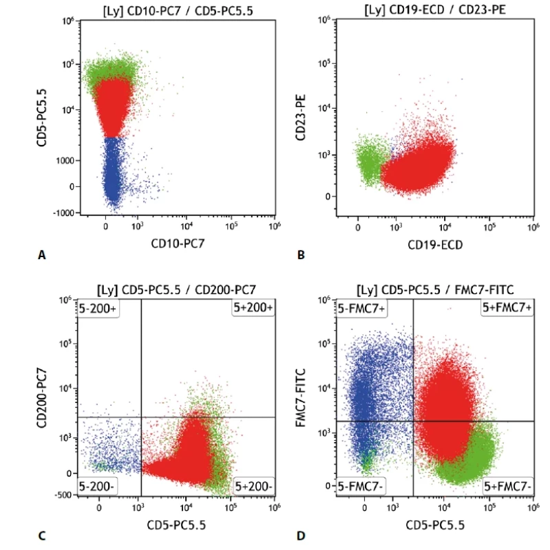 Lymfom z buněk pláště. Průtoková cytometrie. Gate na lymfocyty. Buňky MCL červeně, ostatní B lymfocyty modře, T lymfocyty a NK buňky zeleně. A - MCL s negativní epresí CD10 a pozitivní CD5, B - MCL s negativní expresí CD23, C - MCL s negativní expresí CD200, D - MCL se slabě pozitivní expresí antigenu FMC7.