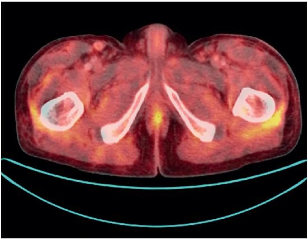 PET-CT vyšetření. Difuzně lehce vyšší konzumpce glukózy v síťovitě zastřeném podkoží na trupu.