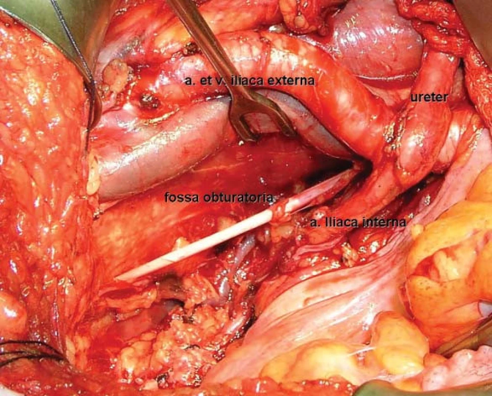 Peroperační obrázek pravé poloviny malé pánve po ukončení lymfadenektomie a odstranění močového měchýře.