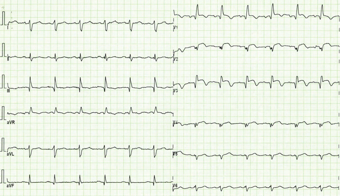 EKG při přijetí pacientky. Blok pravého Tawarova raménka a známky subakutního infarktu myokardu na přední stěně s elevacemi ST segmentu a již vytvořenými Q vlnami ve svodech V&lt;sub&gt;1&lt;/sub&gt;– V&lt;sub&gt;5&lt;/sub&gt;.
