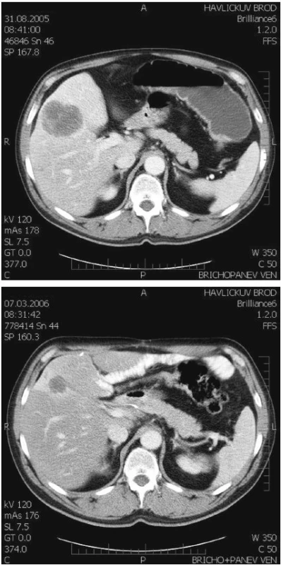 CT obraz regrese další metastázy. Nahoře před, dole po chemoterapii
Fig. 2. CT view of regression of another metastasis. Prior to chemotherapy (upper) and following chemotherapy (lower)
