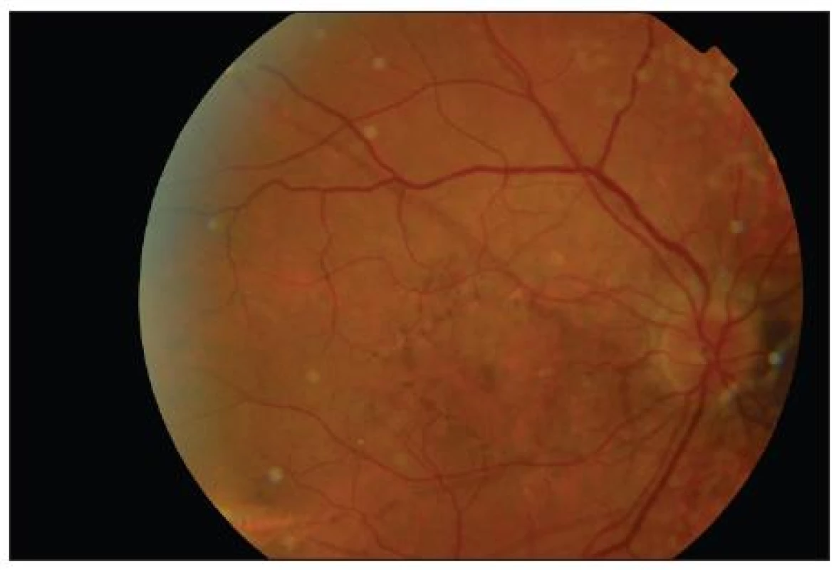 Očné pozadie pravého oka. Peripapilárna atrofia chorioidey a atrofia pigmentového epitelu sietnice v celej makulárnej krajine s presvitaním hnedastých angioidných prúžkov