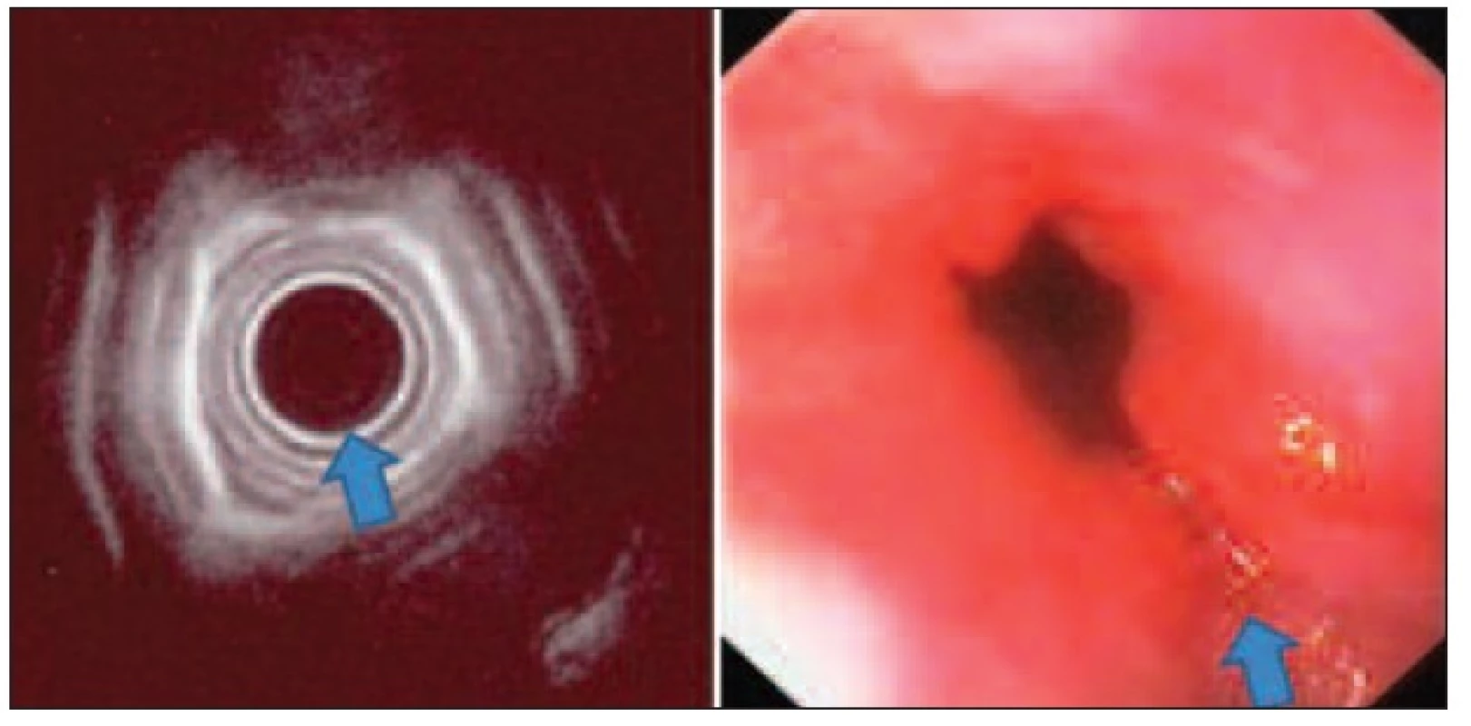 Radiální EUS jícnu v korelaci s endoskopickým nálezem při časném adenokarcinomu v terénu Barrettova jícnu – nerovnosti a rigidita stěny jícnu, bez invaze submukózy, provedena endoskopická mukozektomie
Fig. 3: Radial oesophageal endoscopic ultrasound in correlation with endoscopic picture in early oesophageal carcinoma in Barrett’s oesophagus – roughness and rigidity of the oesophageal wall, without submucosal invasion, treated by endoscopic musocal resection