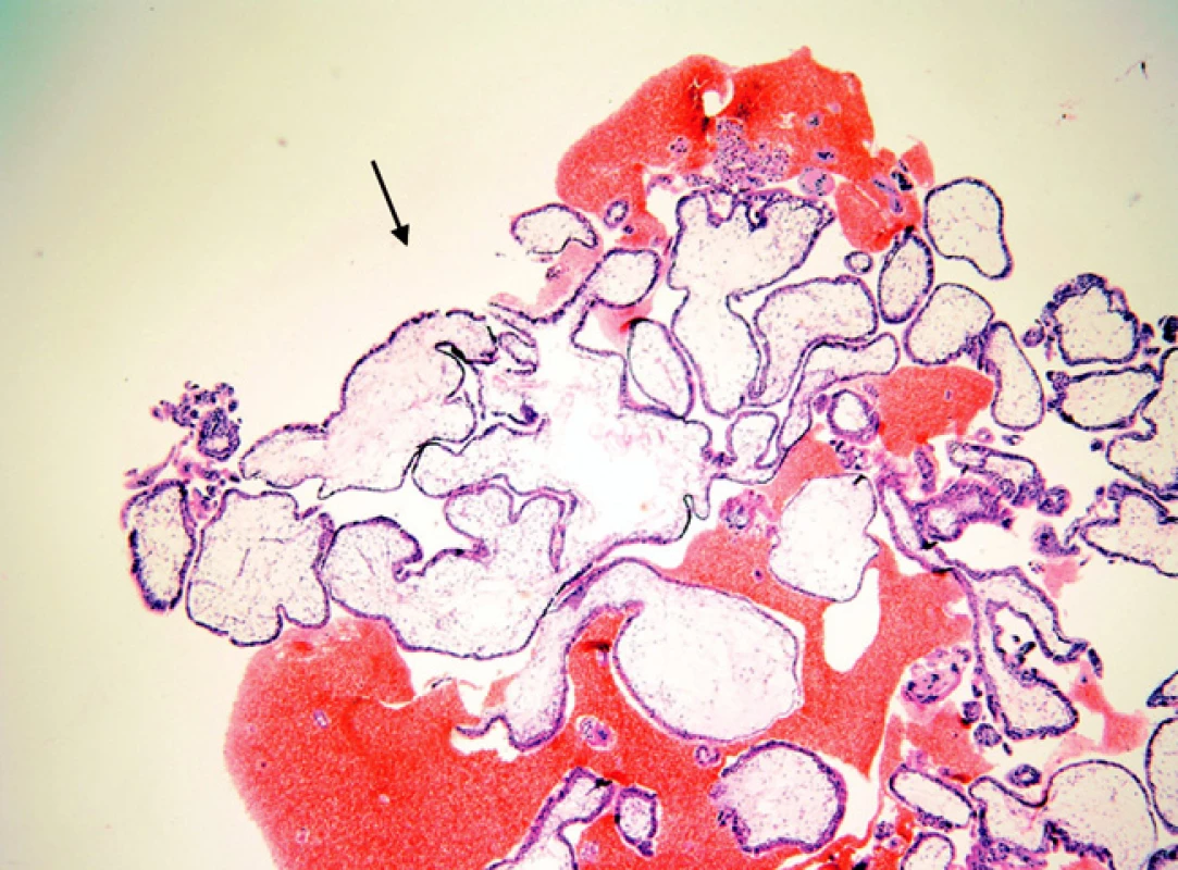 Jiná část nezralé moly hydatidózy z obrázku 3 (šipka)