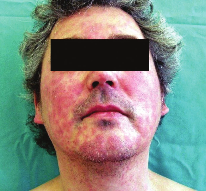 Živě červená splývající ložiska na obličeji a krku, otok a erytém očních víček – airborne dermatitis