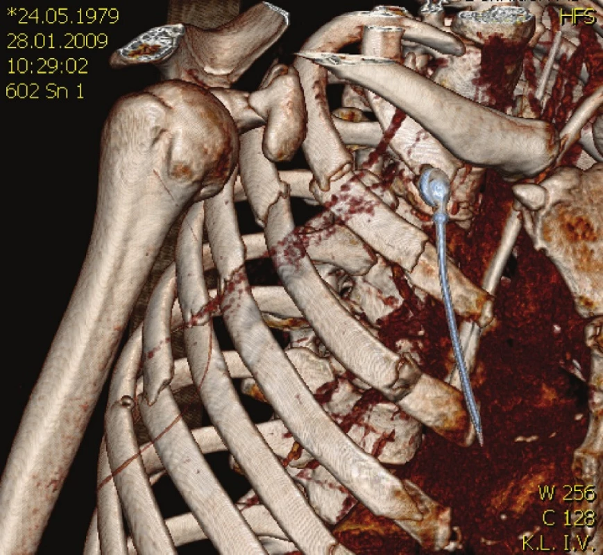 3D CT rekonstrukce u blokové zlomeniny žeber pravé poloviny hrudníku
Fig. 3. 3D CT reconstruction of the right-sided block rib fracture