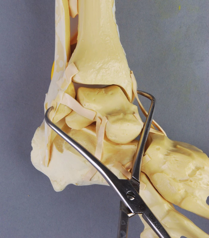 Zwippova metoda repozice distální fibuly do incisury tibie pomocí kostních kleští