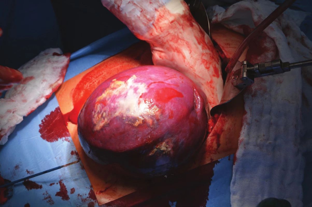 Peroperační foto sleziny během splenektomie
Fig. 5: Perioperative photo of the spleen during splenectomy