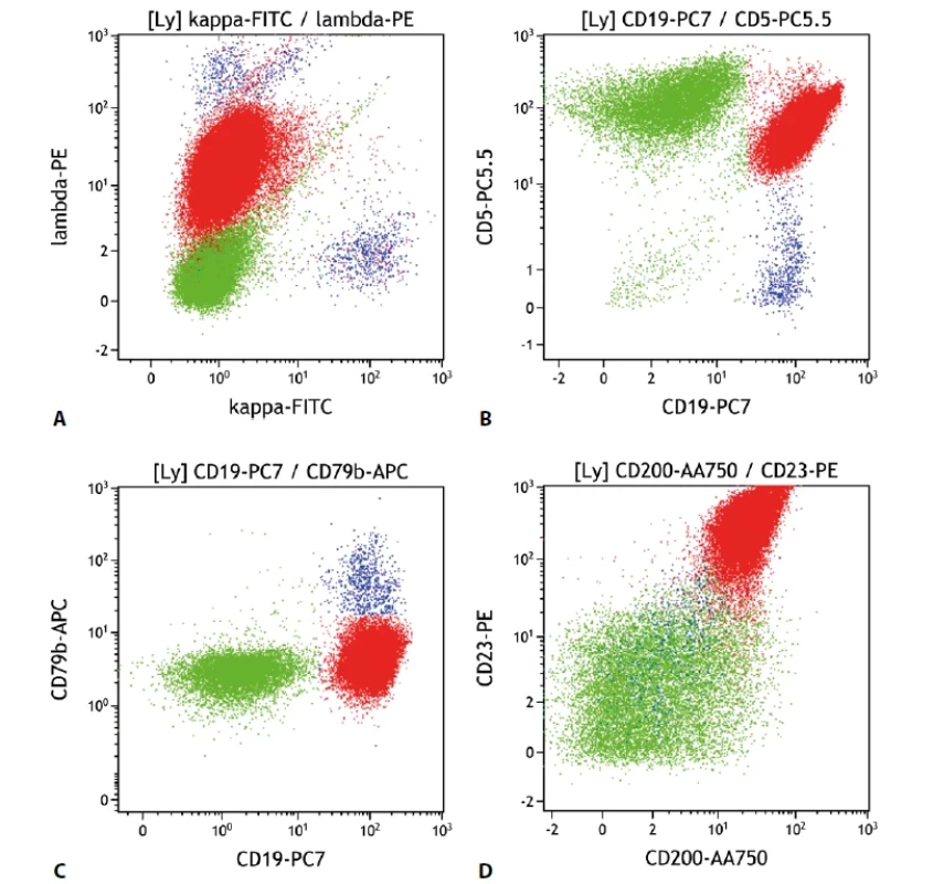 Malobuněčný B lymfom. Průtoková cytometrie. Gate na lymfocyty. Buňky CLL červeně, ostatní B lymfocyty modře, T lymfocyty a NK buňky zeleně. A - CLL s monoklonální expresí povrchových lehkých imunoglobulinových řetězců lambda (slaběji), B - CLL s expresí CD19 a CD5, C - CLL s velmi slabou expresí CD79b, D - CLL se silnou pozitivitou CD23 a CD200.