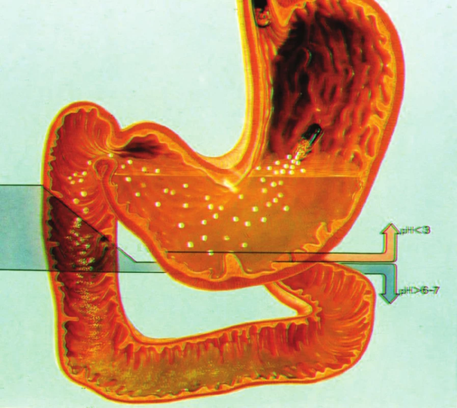 Grafické zobrazení procesu uvolnění granulí s ochranným obalem proti inaktivaci enzymů žaludeční kyselinou chlorovodíkovou v žaludku a jejich synchronní proniknutí do horní části duodena se žaludečním chymem (Z granulí jsou v duodenu, v souvislosti s hodnotou duodenálního pH, uvolněny pankreatické enzymy.)
