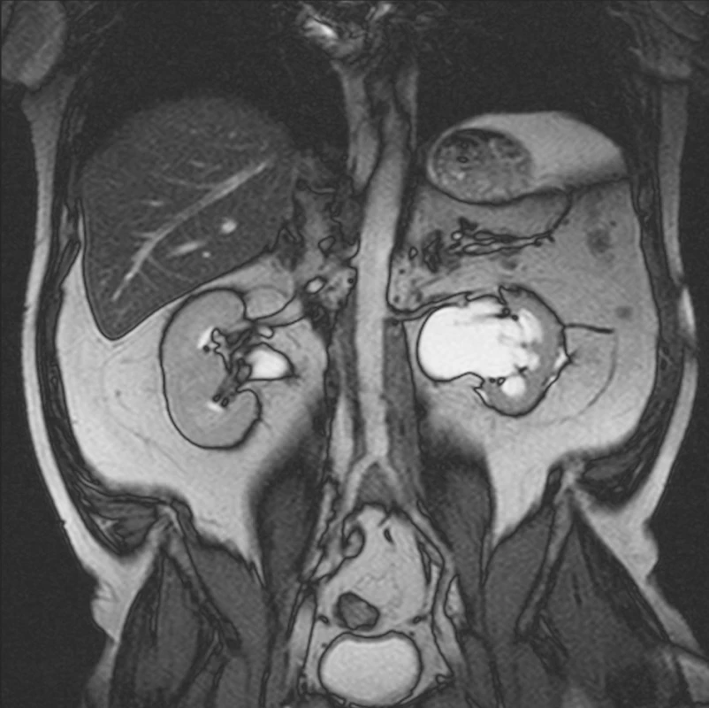 MRI vyšetření provedené 12 měsíců po zahájení terapie tamoxifenem prokazuje regresi rozsahu retroperitoneální fibrotické tkáně. Současně prokazuje ústup dilatace dutého systému obou ledvin a obou ureterů.