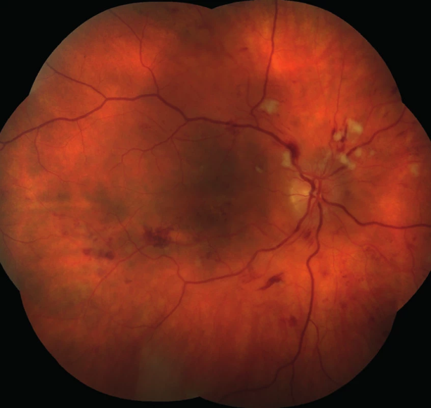 Pravé oko. Výrazná hypertonická retinopatie, stadium 3–4 dle Keitha.