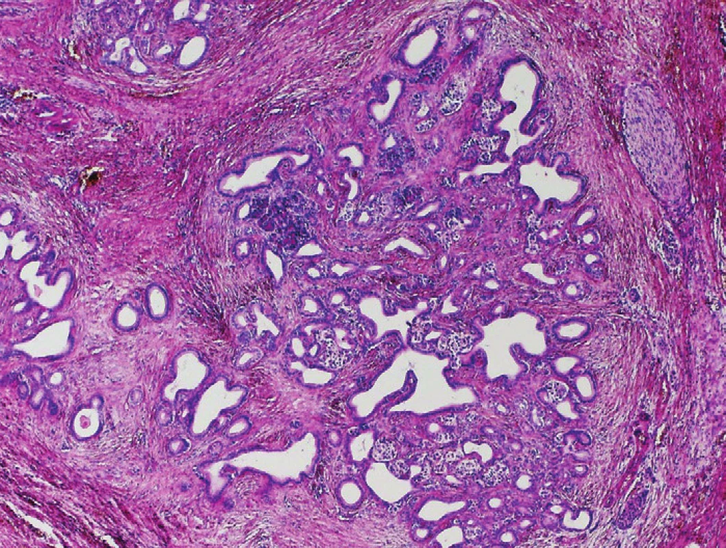 Chronická pankreatitida (CP). Perzistující lobulární uspořádání epiteliálních struktur pankreatické tkáně v terénu CP se zachovalou vazbou duktálních struktur na reziduální acinární struktury a ostrúvky endokrinního pankreatu. Barveno hematoxylinem eozinem (zvětšení 40x).