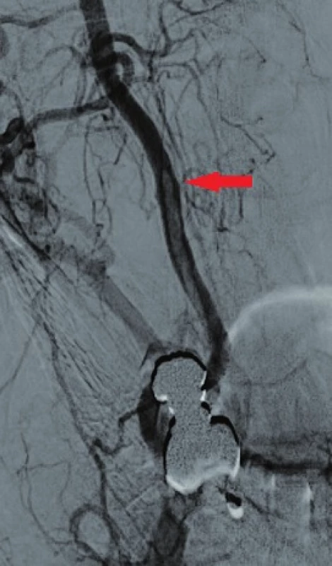 Angiografické zobrazení stenozy a volně vlajícího trombu
Fig. 5: Angiography presenting the stenosis and the free-floating thrombus