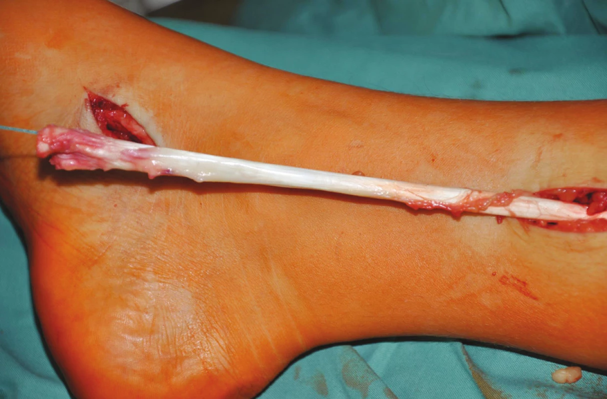 Vypreparovaná šlacha m. tibialis posterior protažena do incize na mediální straně bérce
Fig. 1: The dissected posterior tibial tendon inserted into the incision on the medial side of the shank