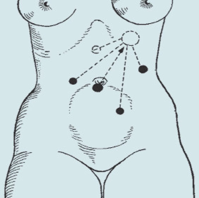 Umístění trokarů při laparoskopické transperitoneální levostranné adrenalektomii