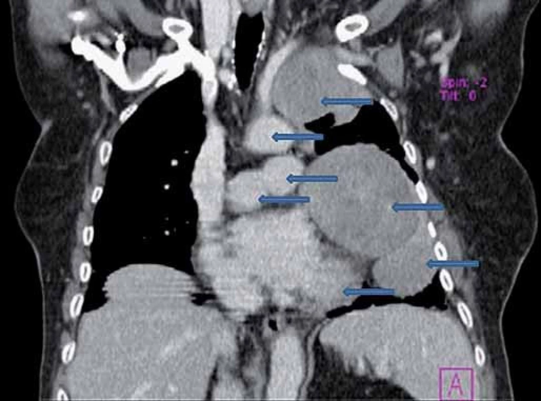CT hrudníka – multifokulárna tumorózna masa v celom ľavom hemitoraxe.
